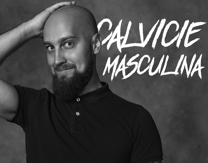 Calvície masculina