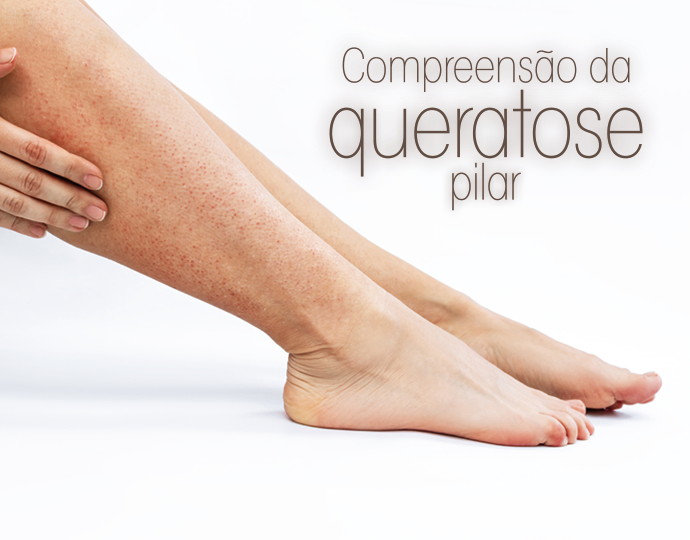 Compreensão da queratose pilar